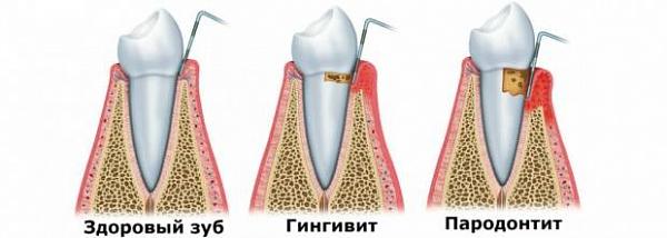Лечение кариеса зубов в Уфе